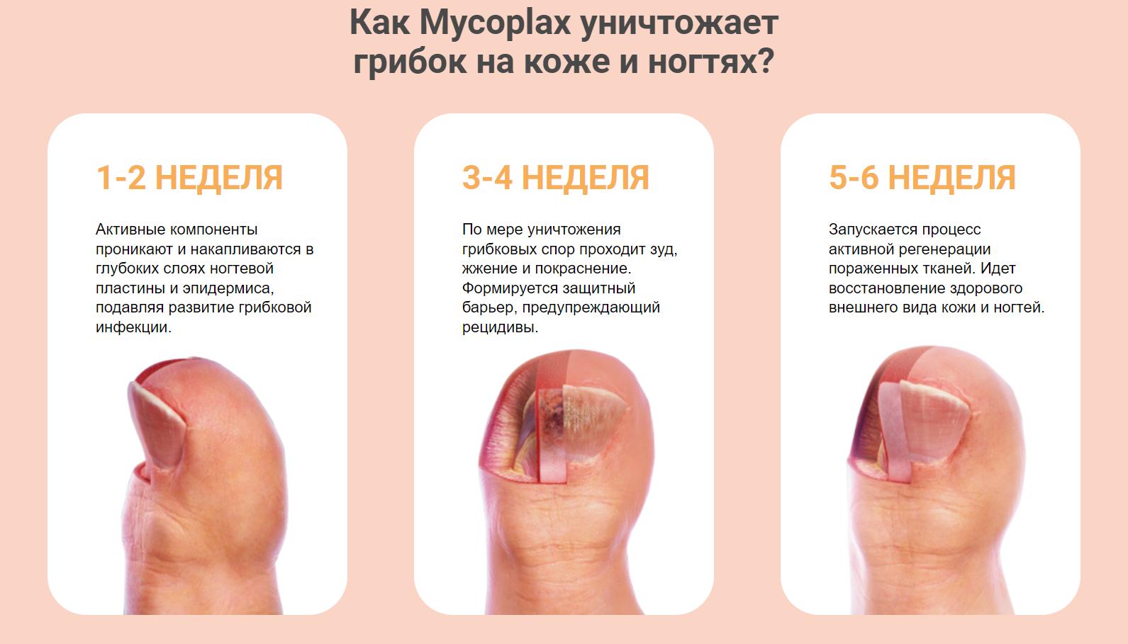 Какой анализ на грибок ногтей. Грибок ногтей на ногах начало. Грибок ногтей результат анализа. Грибок ногтей на ногах симптомы. Какой анализ на грибок ногтей.